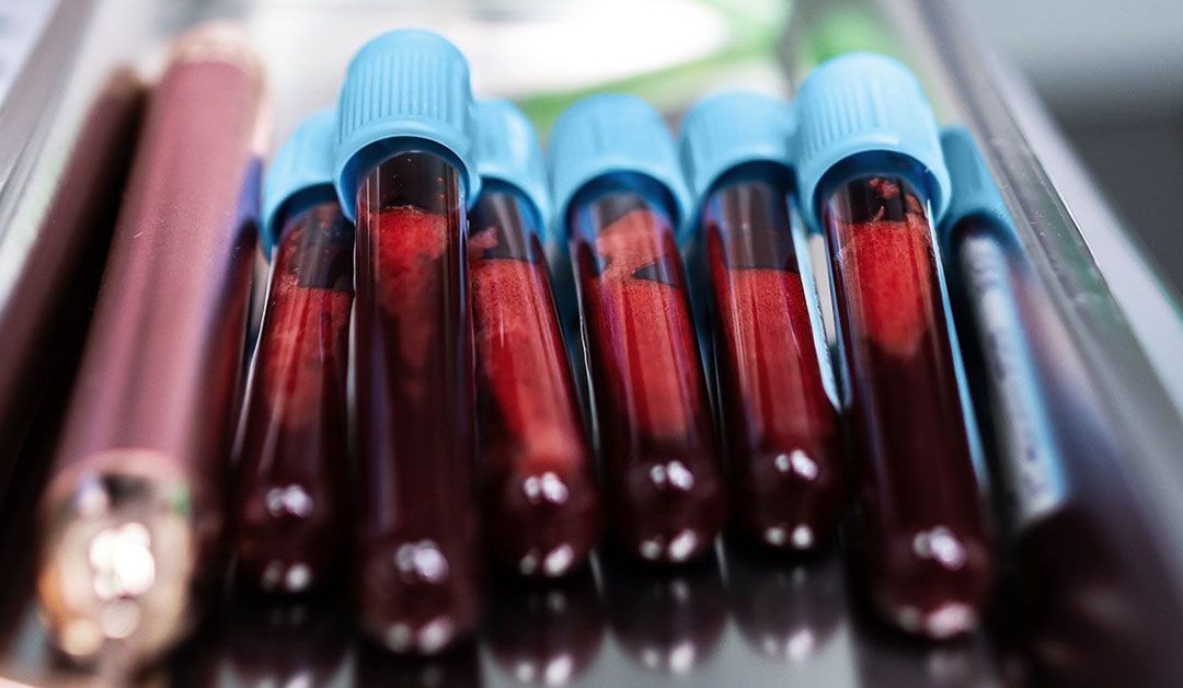 Liquid biopsy test may offer faster feedback on breast cancer therapy