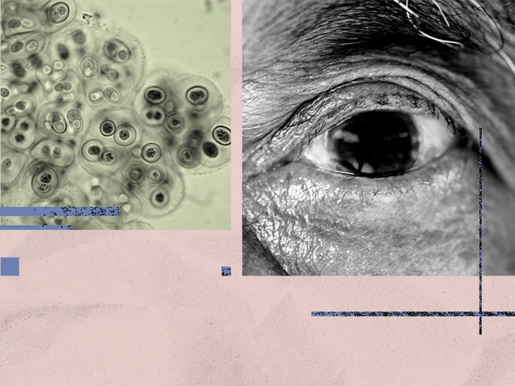Could this common bacteria in the eye be driving Alzheimer’s disease?