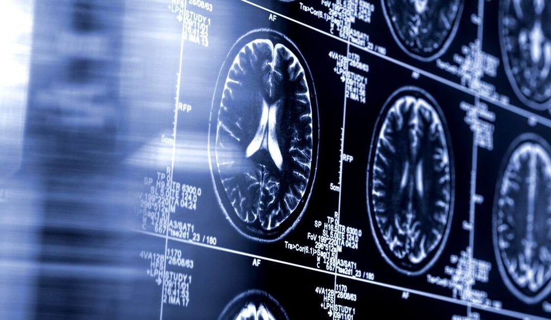 AI-powered stroke tool linked to improved patient outcomes in large clinical trial