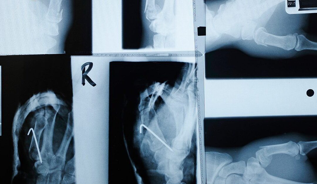 GLP-1s may aid bone health as well as weight loss in type 2 diabetes