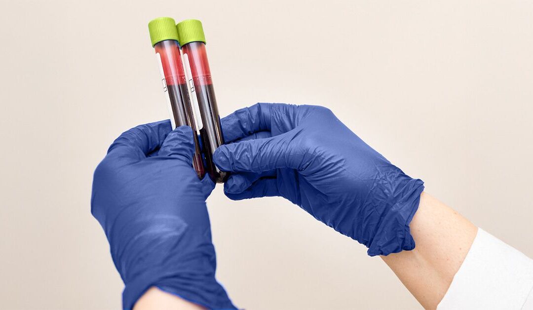 Alzheimer’s blood test around ages 53-69 may help detect early cognitive decline
